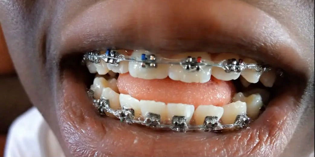 Can You Play Trumpet with Braces?